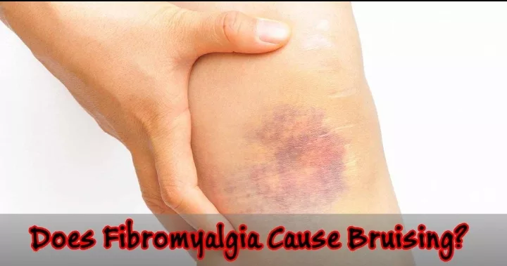 Fibromyalgia and Bruising: Effects of an invisible disease