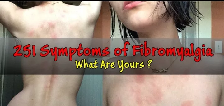 251 Symptoms of Fibromyalgia (Hard to Believe). What are Yours?