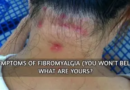 72 Symptoms of Fibromyalgia (Hard to Believe). What are yours?