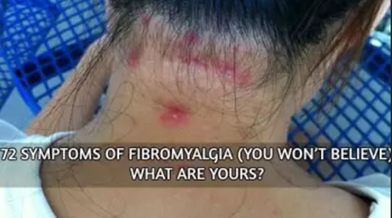 72 Symptoms of Fibromyalgia (Hard to Believe). What are yours?