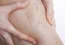 What You Need To Know About Fibromyalgia Spider Veins